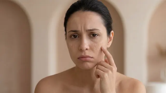 Prenatal Hormonal Changes On Your Skin