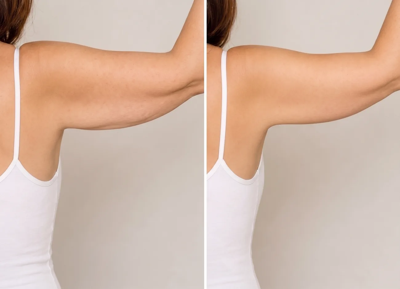 Upper arm before and after LPG endermologie treatment, showing firmer skin