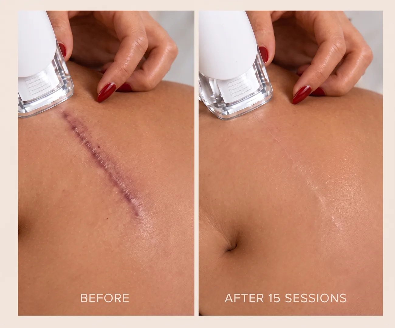 A surgical scar on the abdomen before and after 15 sessions of LPG endermologie treatment