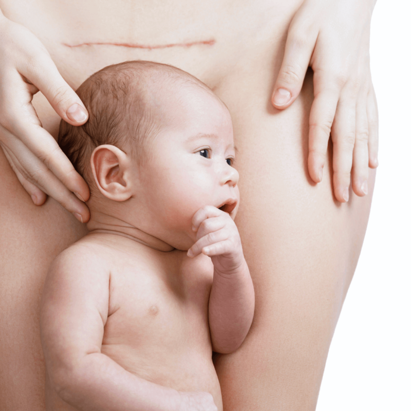 Drainage massage for C-section recovery