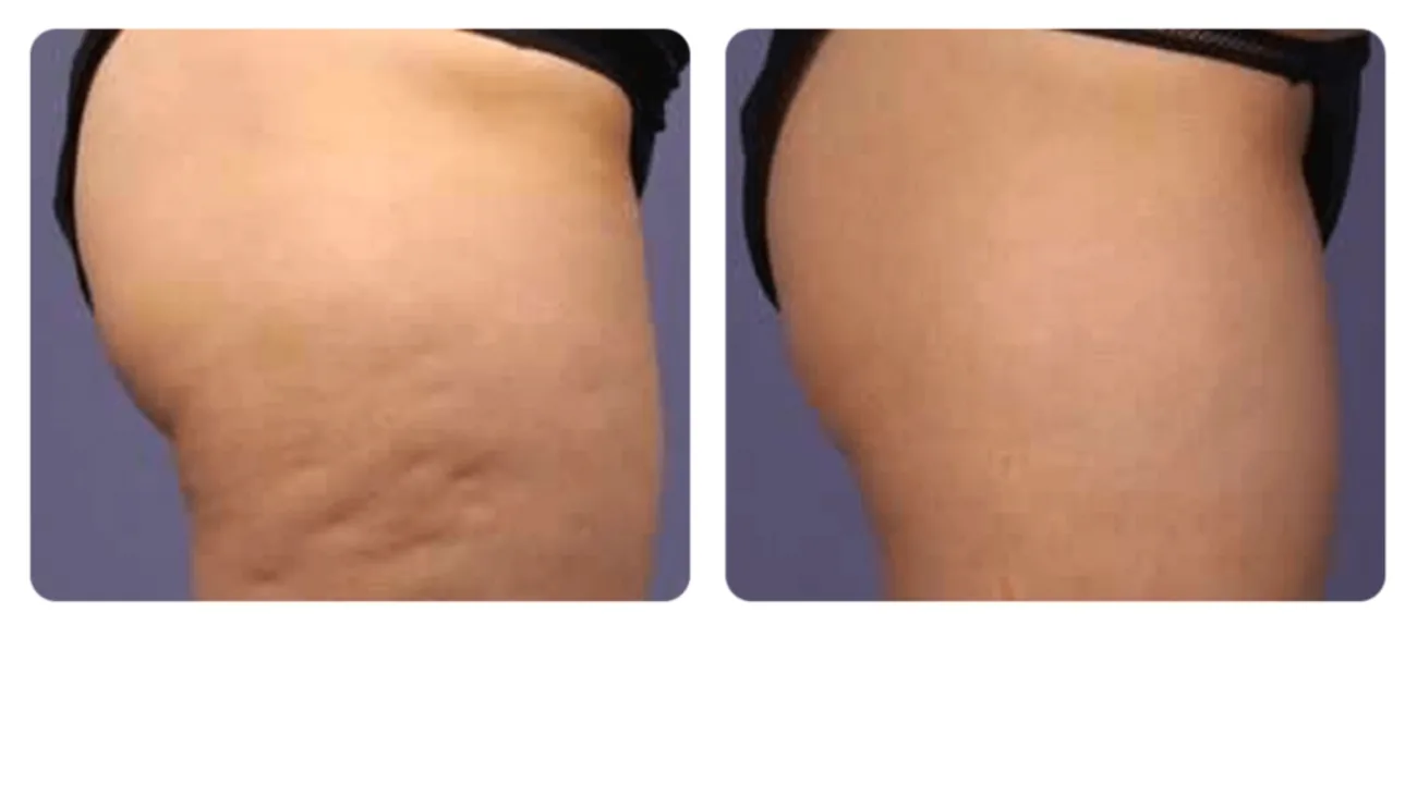 Before-and-after results from Proionic Womb Wellness Therapy at BMB