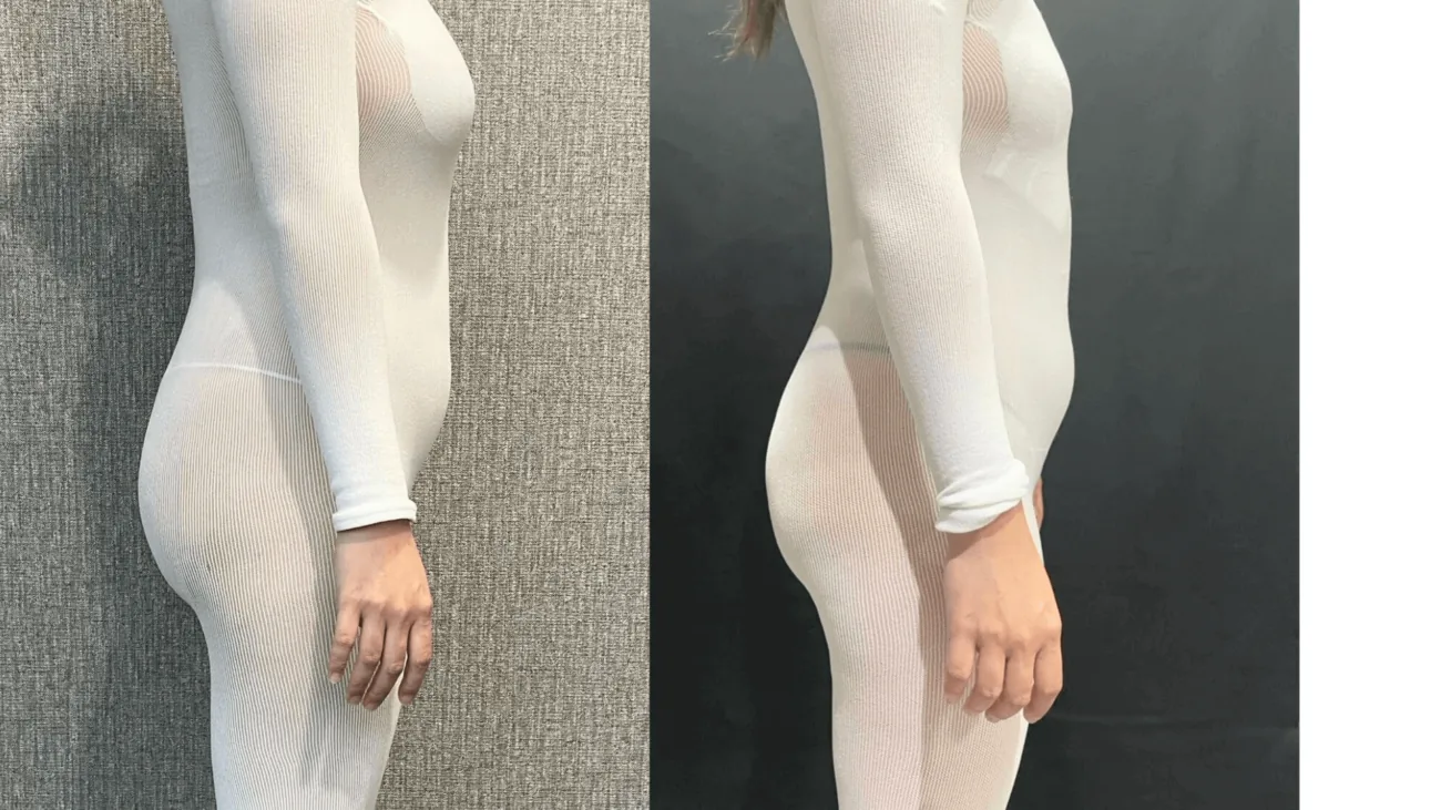 LPG CELLU M6 before-and-after comparison from a BMB postpartum client