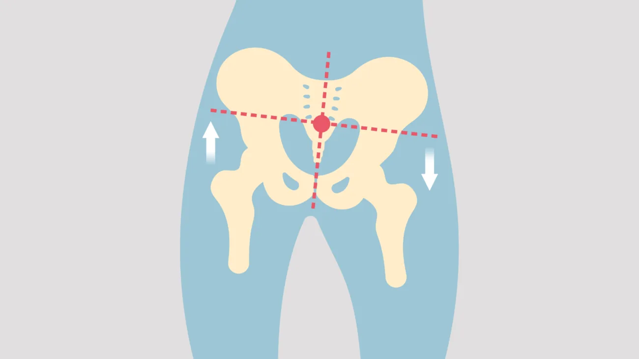 Diagram showing pregnancy-related hip misalignment that SpinalSync addresses